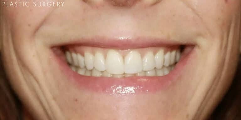 Botox Before & After