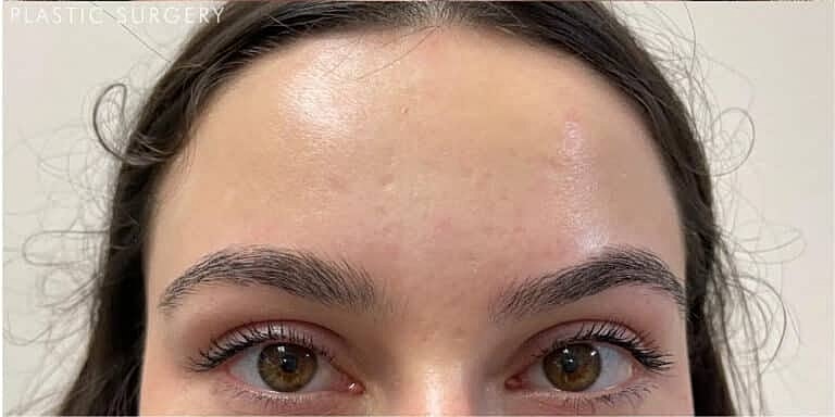 Botox Before & After