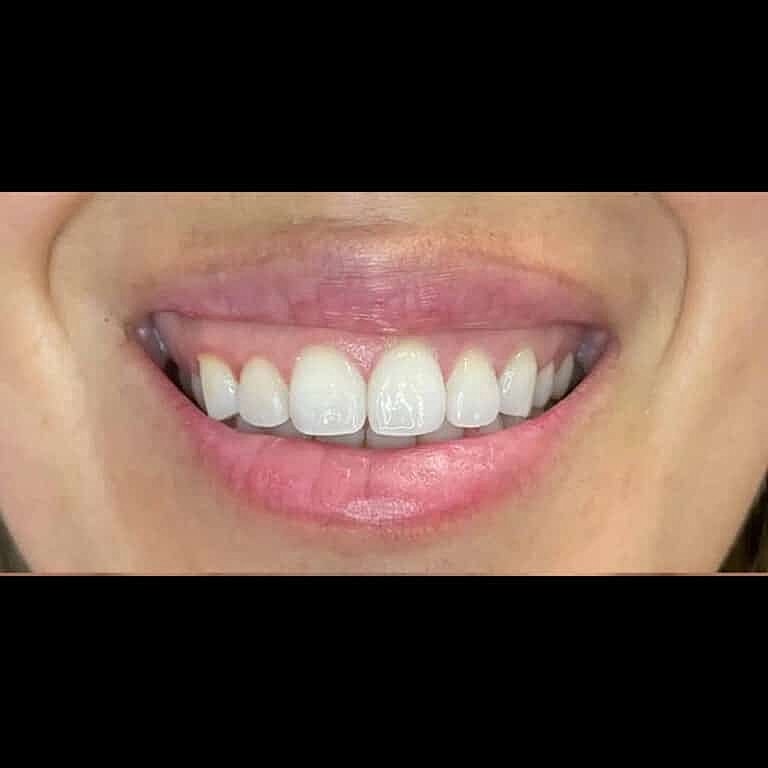 Botox Before & After