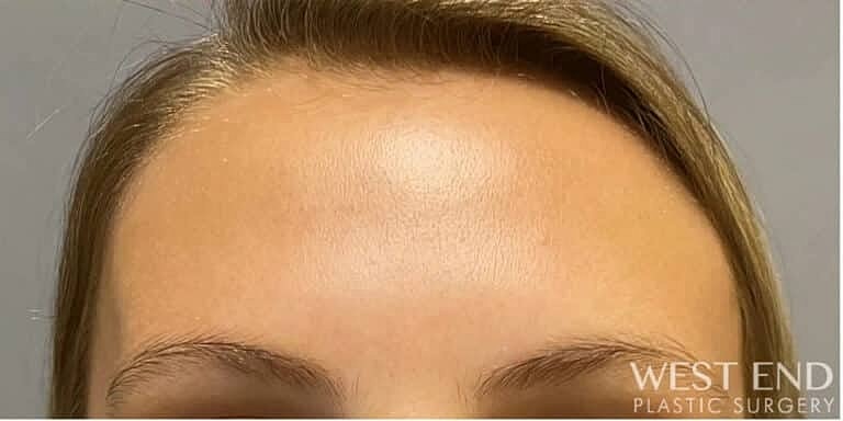 Botox Before & After