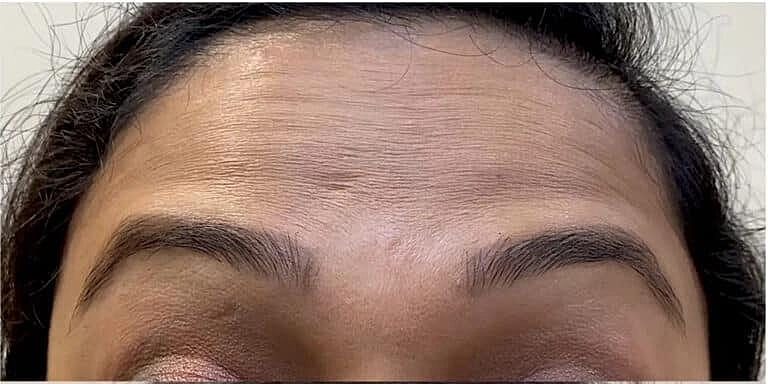 Botox Before & After