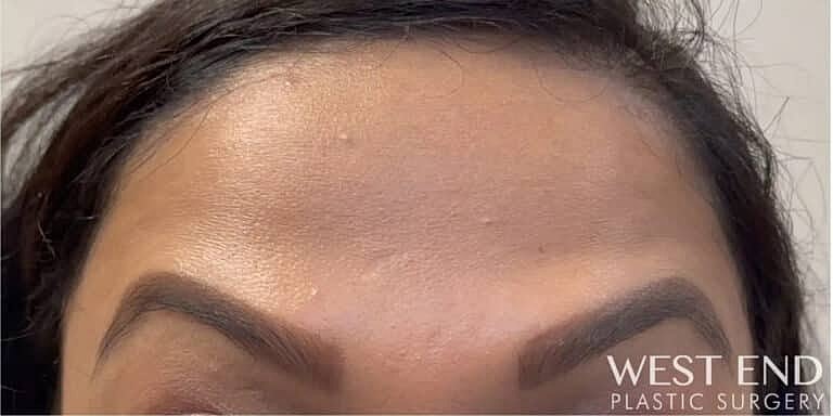 Botox Before & After