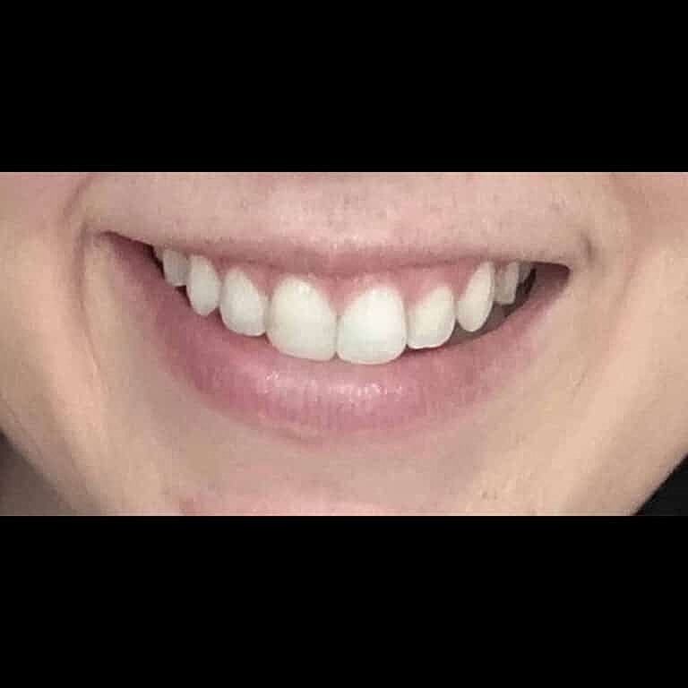 Botox Before & After