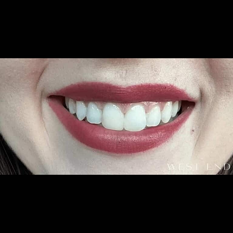 Botox Before & After