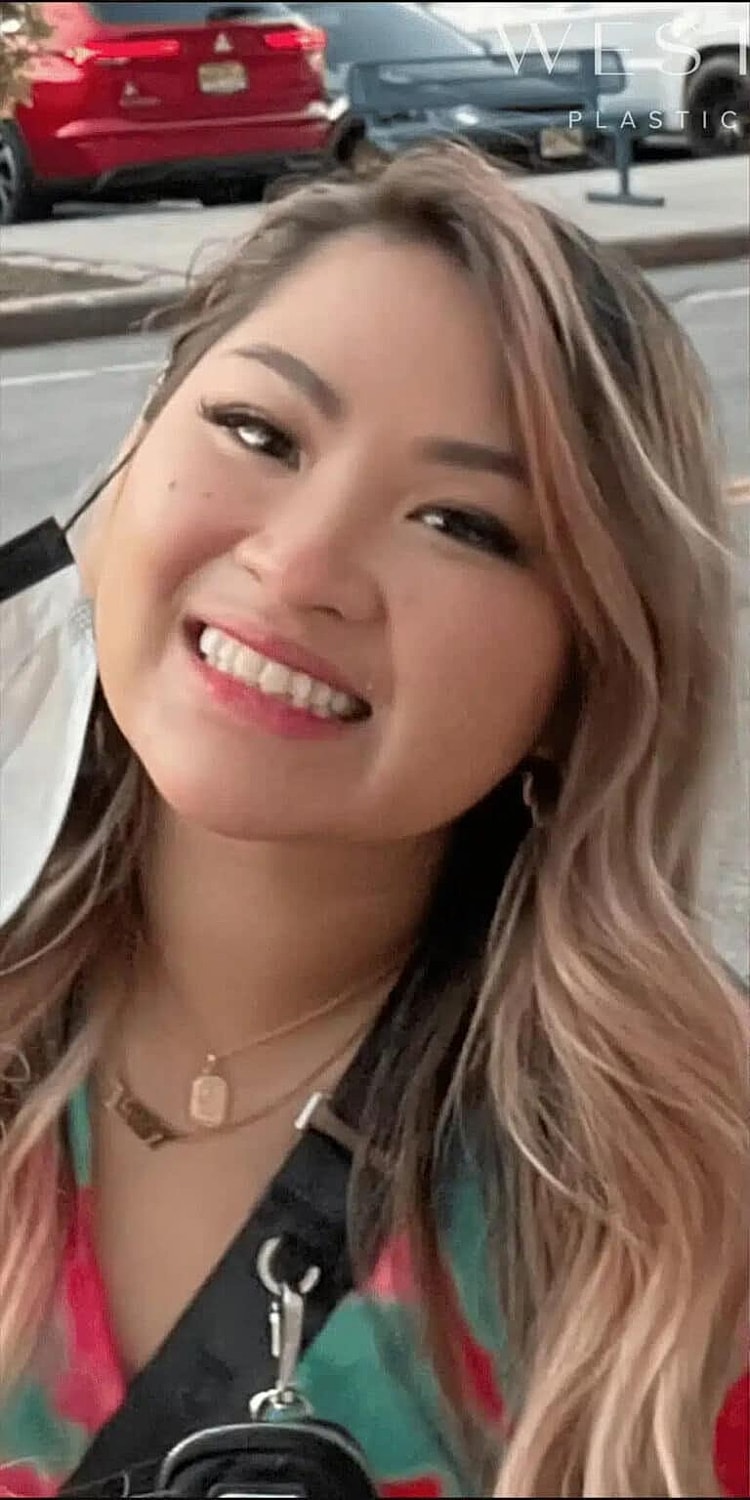 Botox Before & After