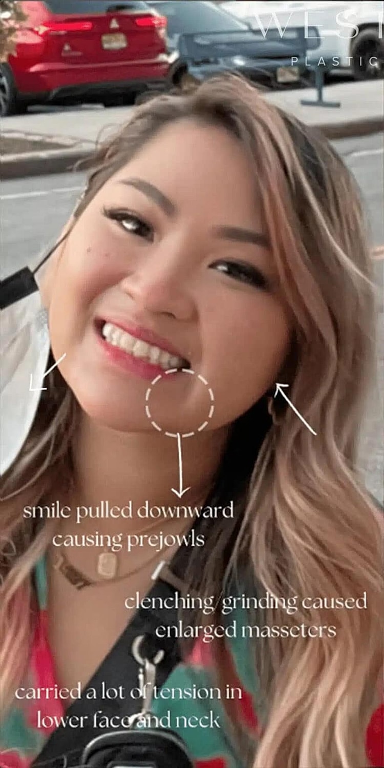 Botox Before & After