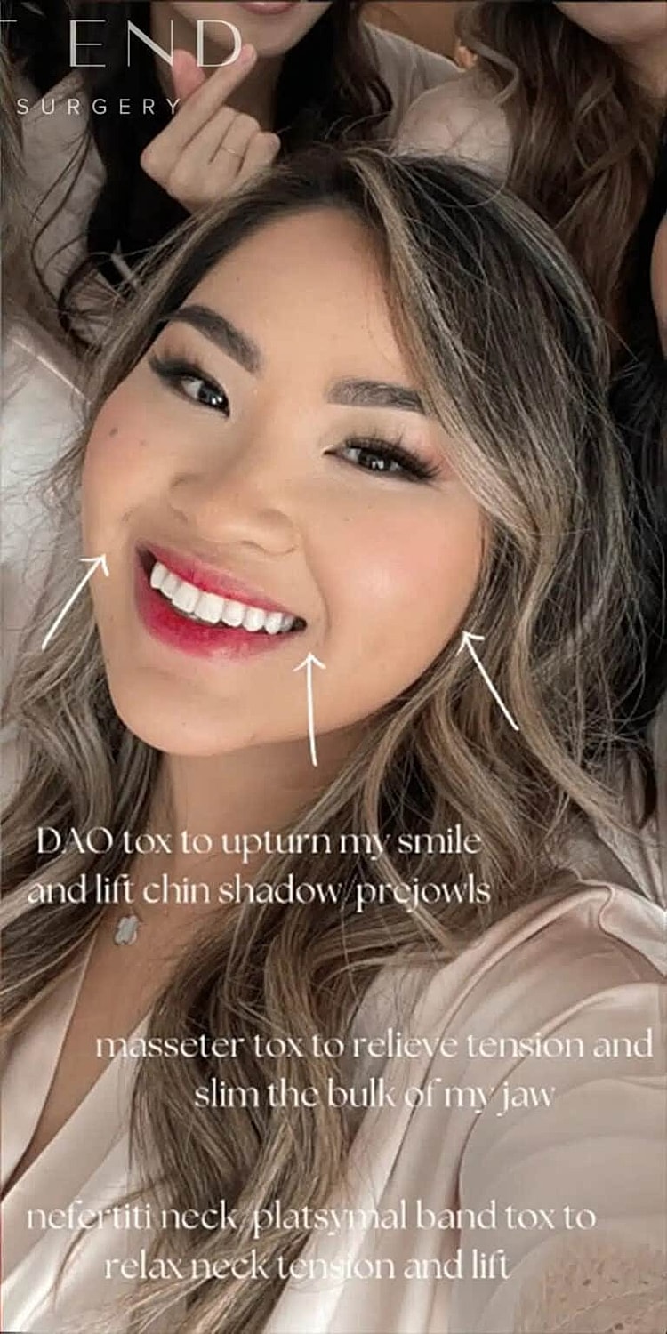 Botox Before & After