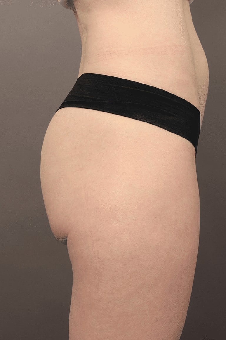 Radiesse Before & After