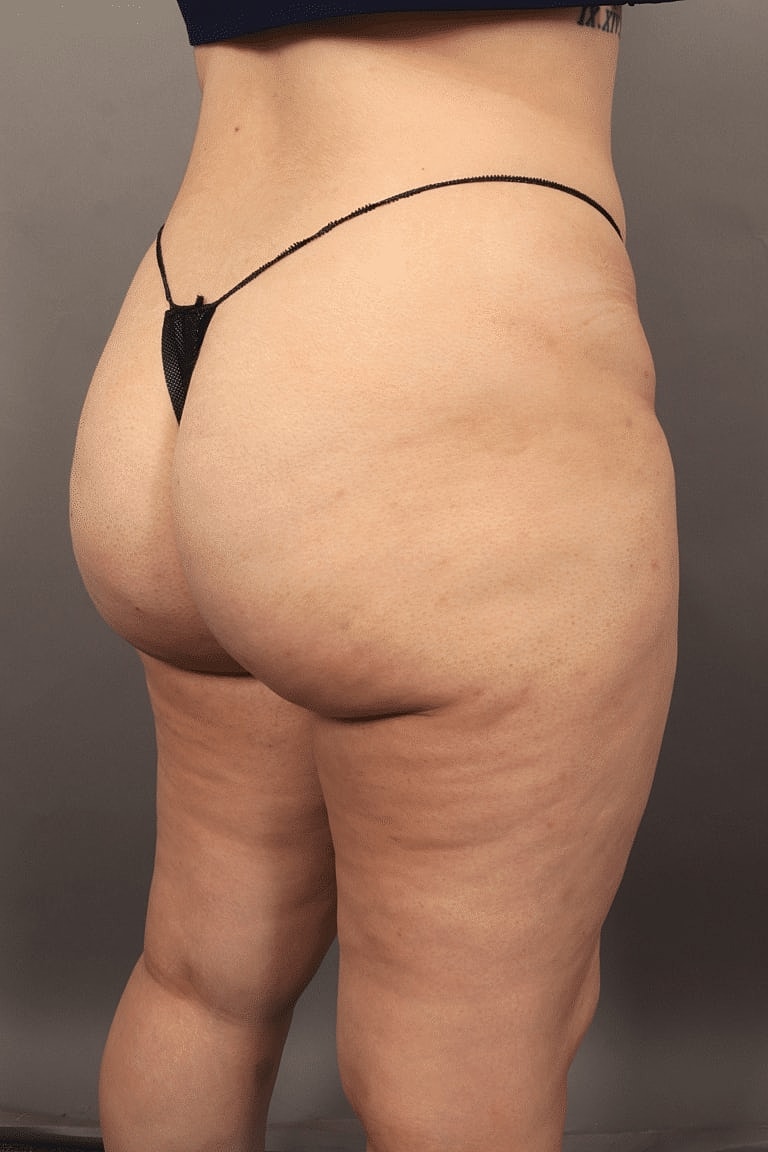 Radiesse Before & After