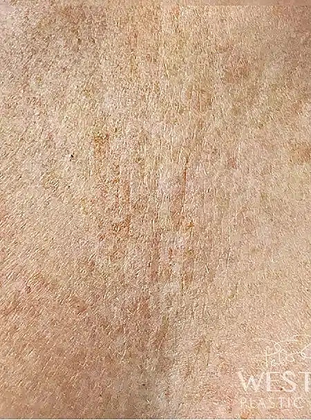 Microneedling Before & After