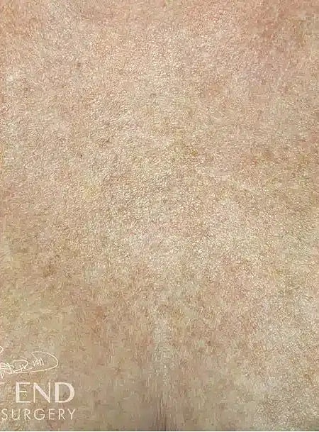 Microneedling Before & After