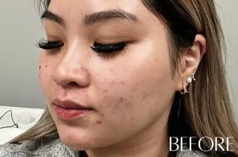 Microneedling Before & After