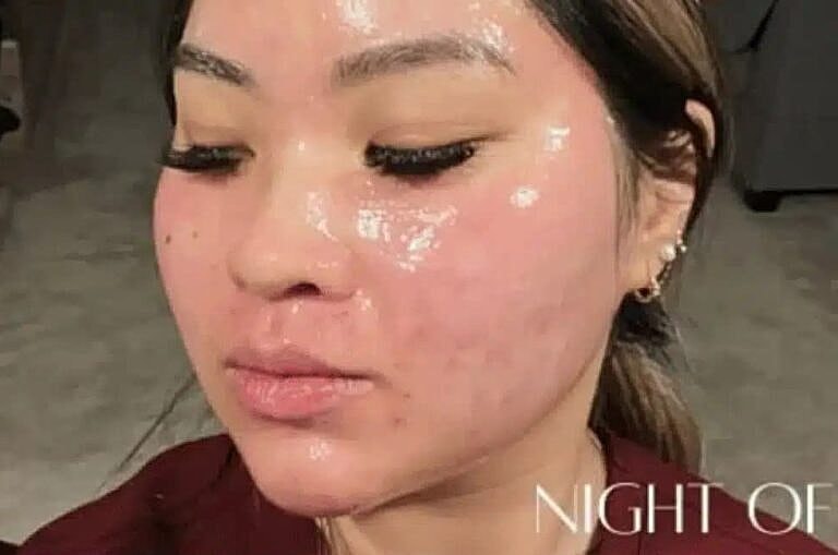 Microneedling Before & After