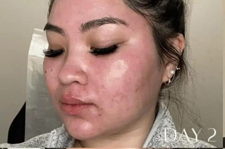 Microneedling Before & After