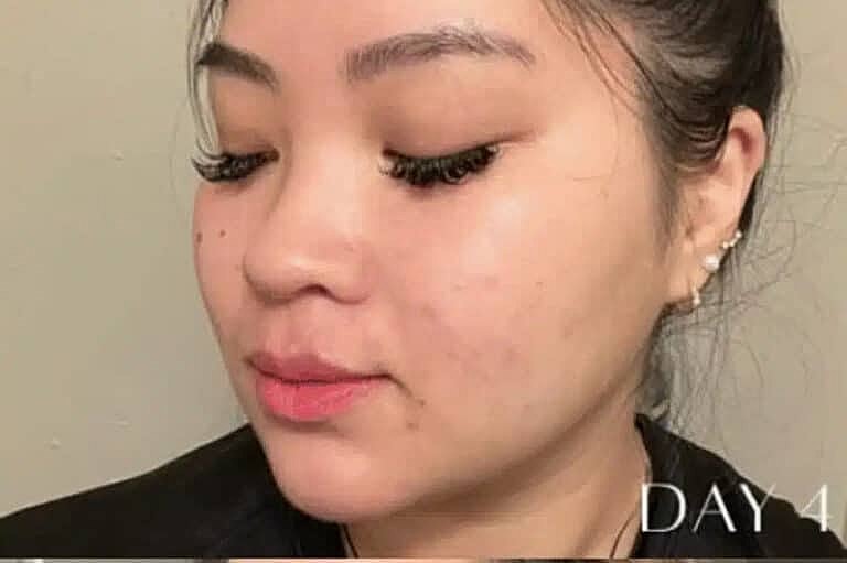 Microneedling Before & After