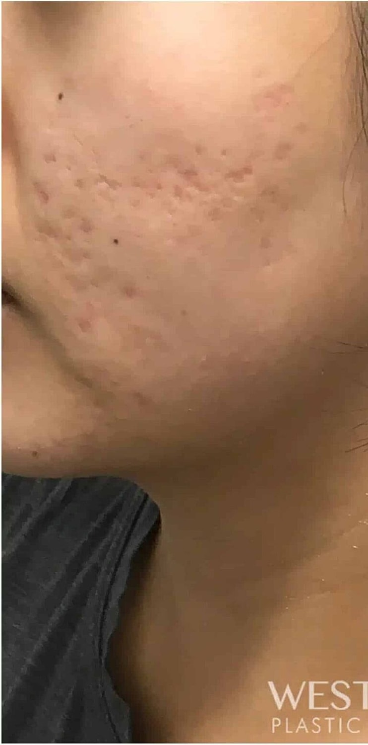 Microneedling Before & After