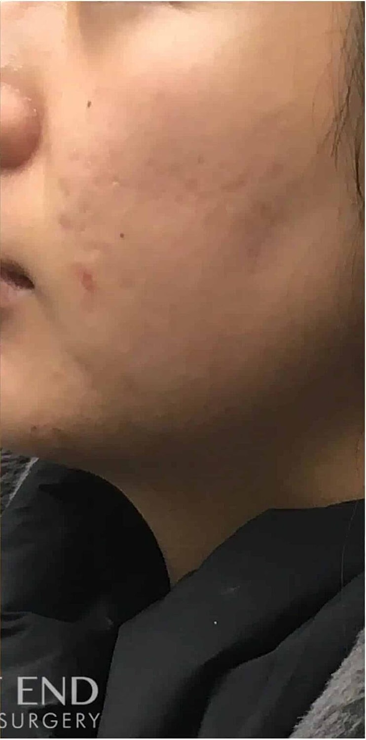 Microneedling Before & After