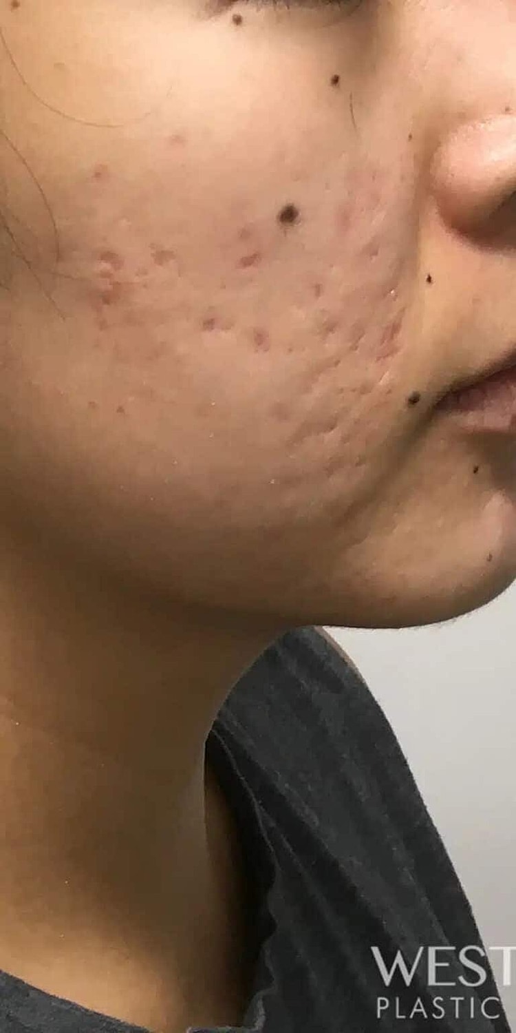 Microneedling Before & After