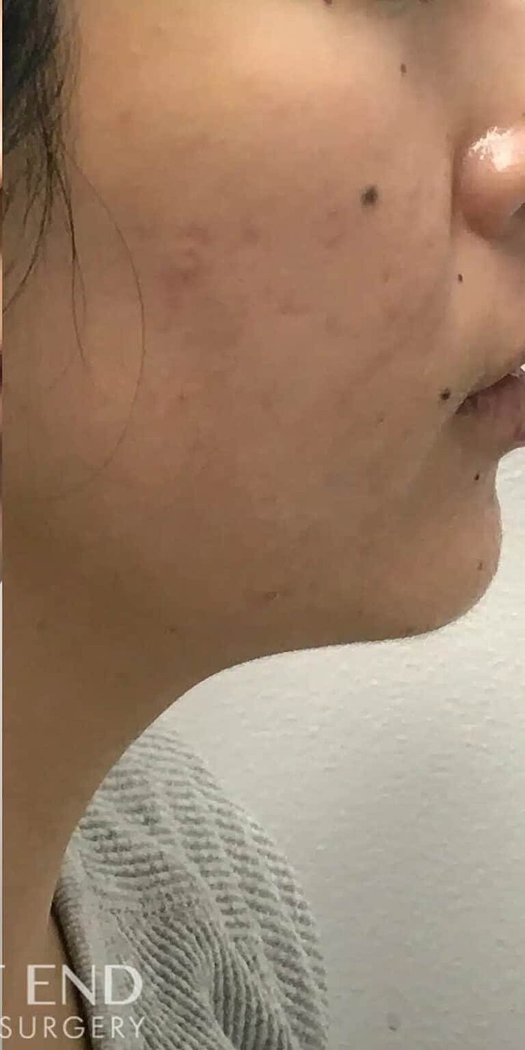 Microneedling Before & After