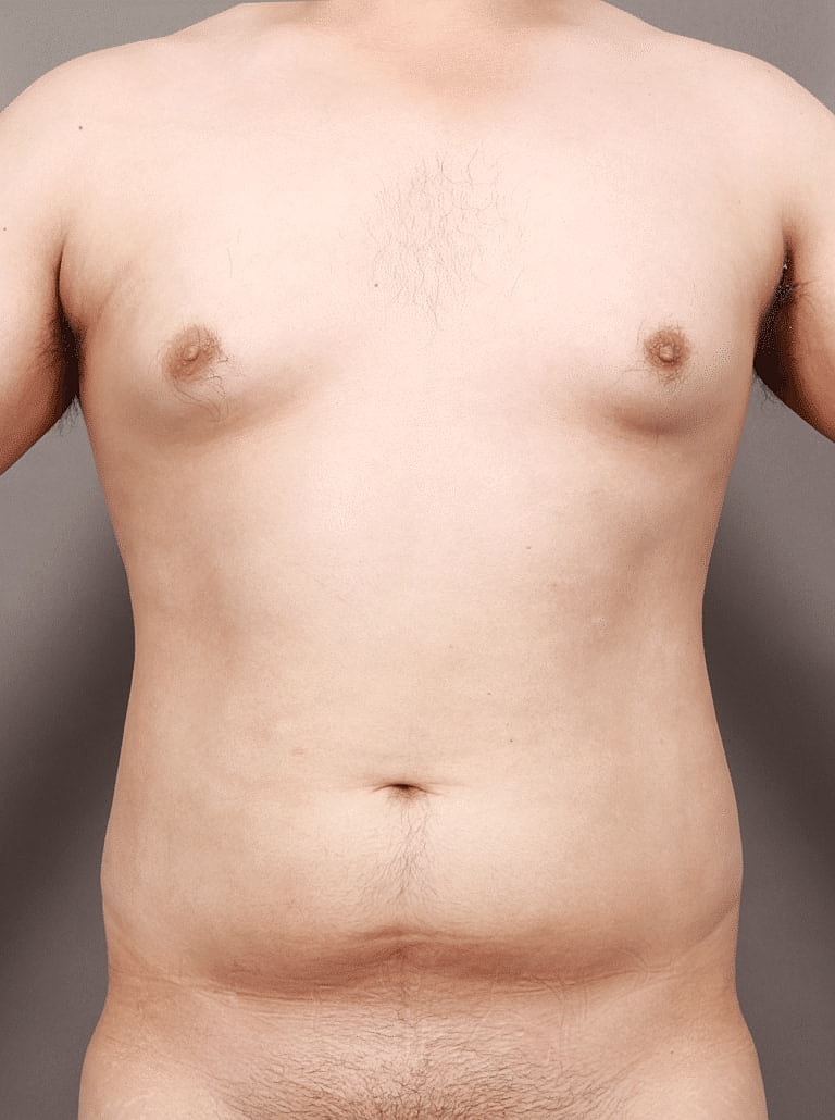 Gynecomastia Before & After