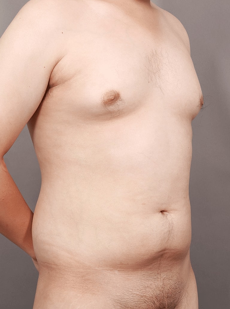 Gynecomastia Before & After