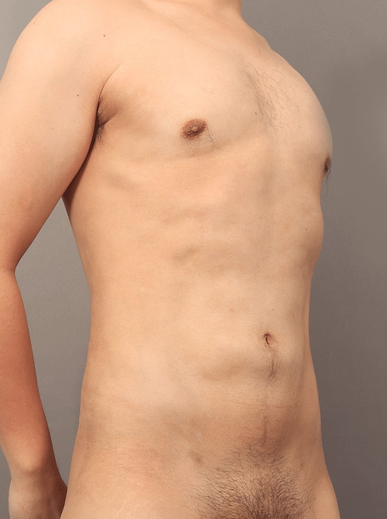 Gynecomastia Before & After