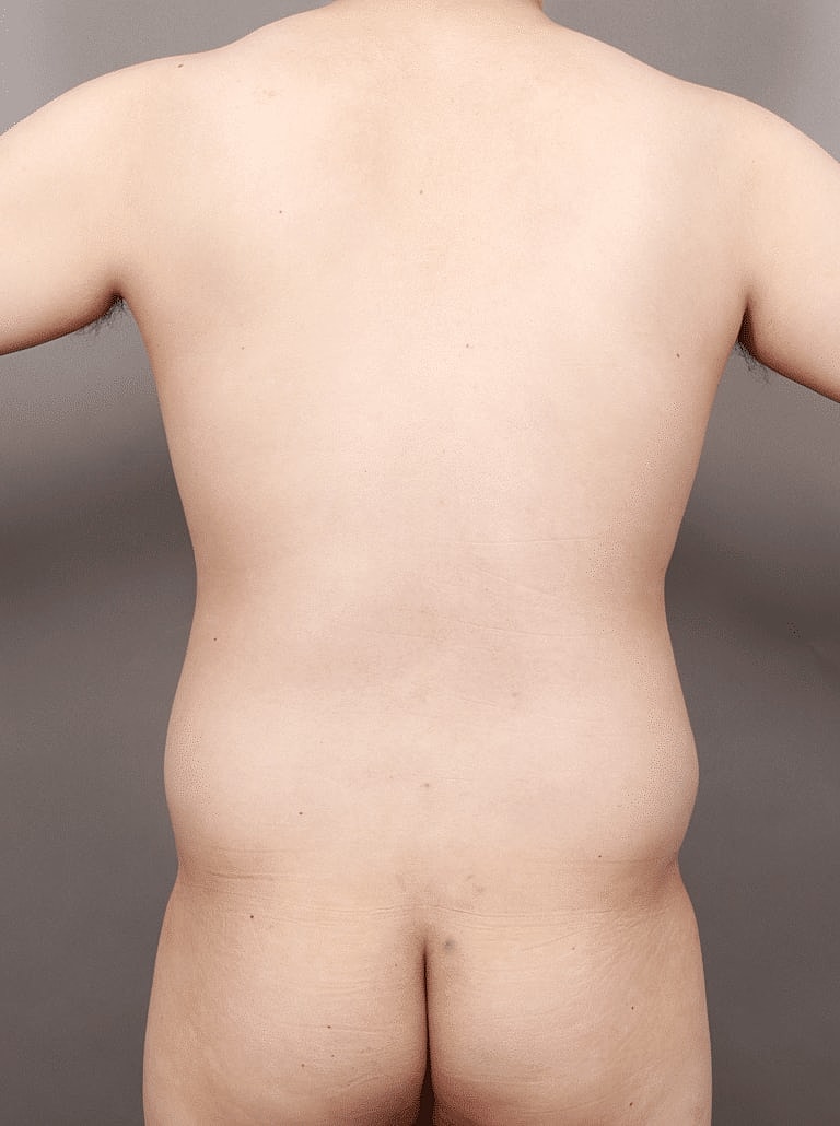 Gynecomastia Before & After