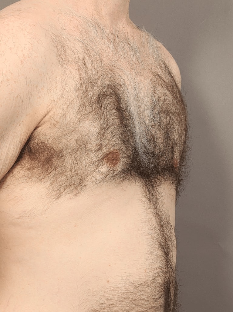 Gynecomastia Before & After