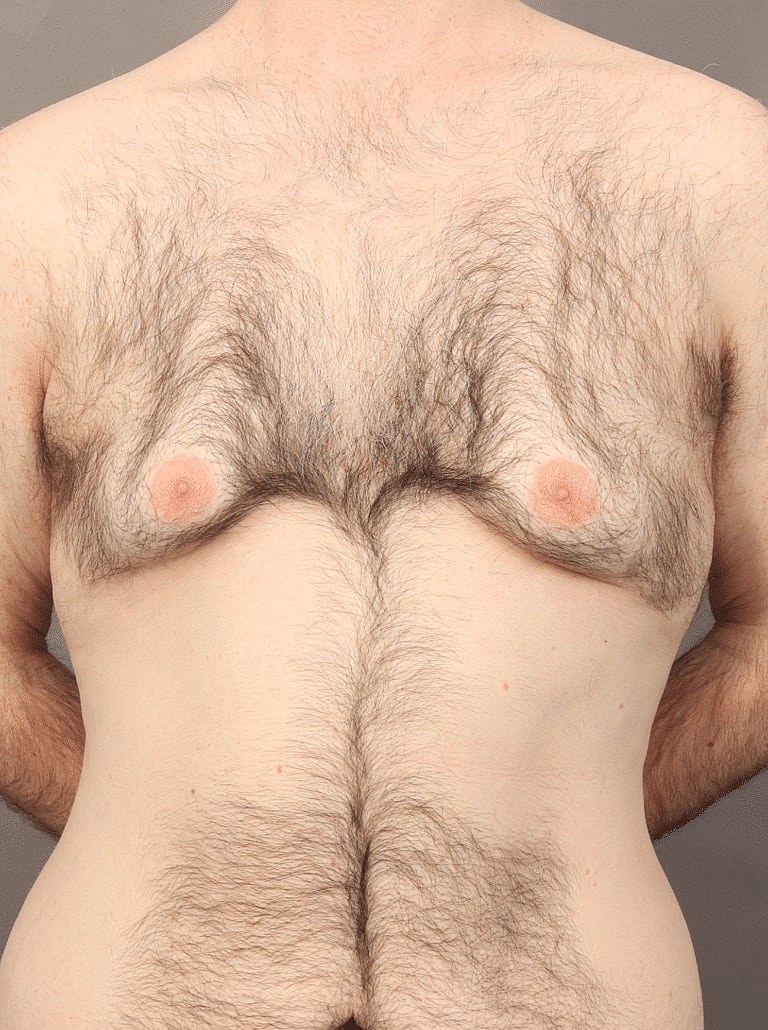 Gynecomastia Before & After