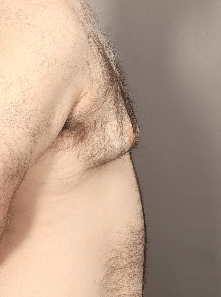 Gynecomastia Before & After