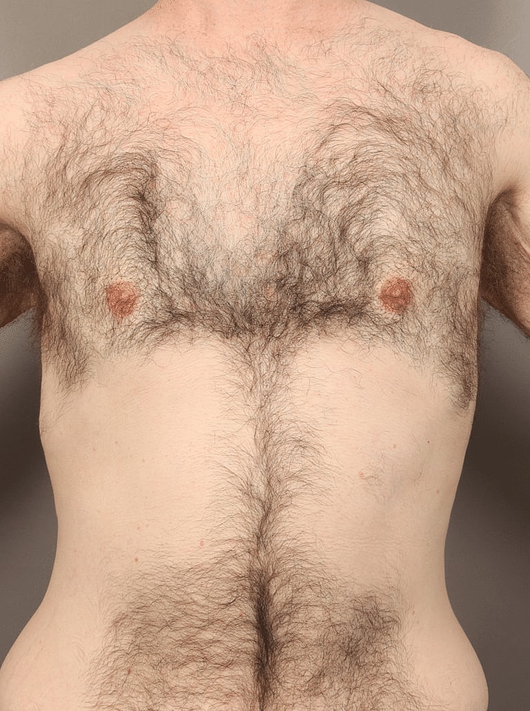 Gynecomastia Before & After