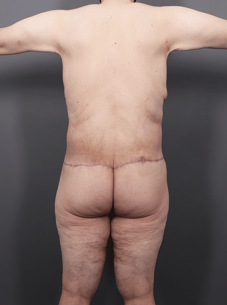 Gynecomastia Before & After