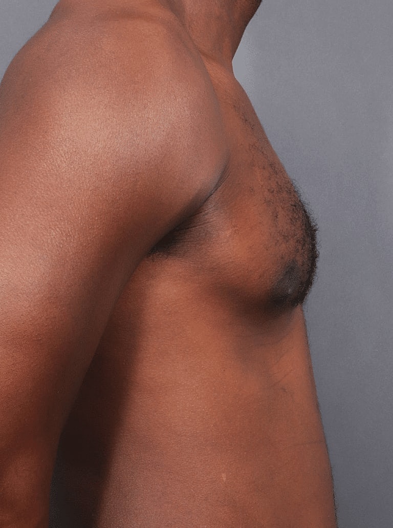 Gynecomastia Before & After