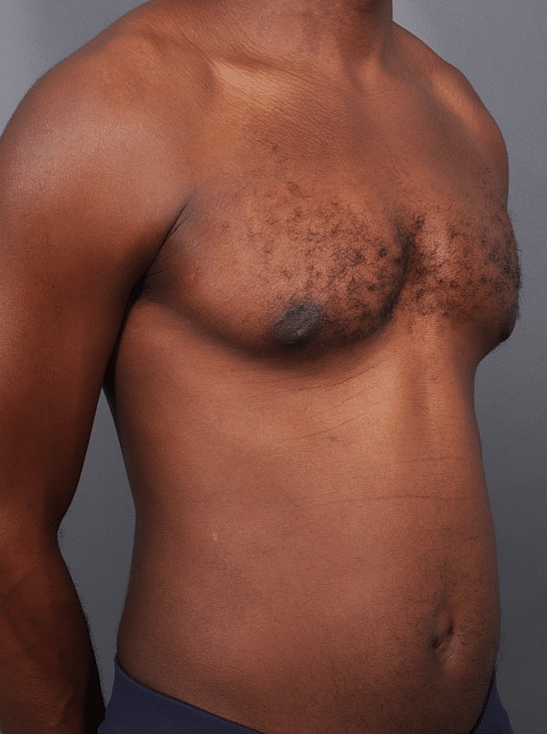Gynecomastia Before & After