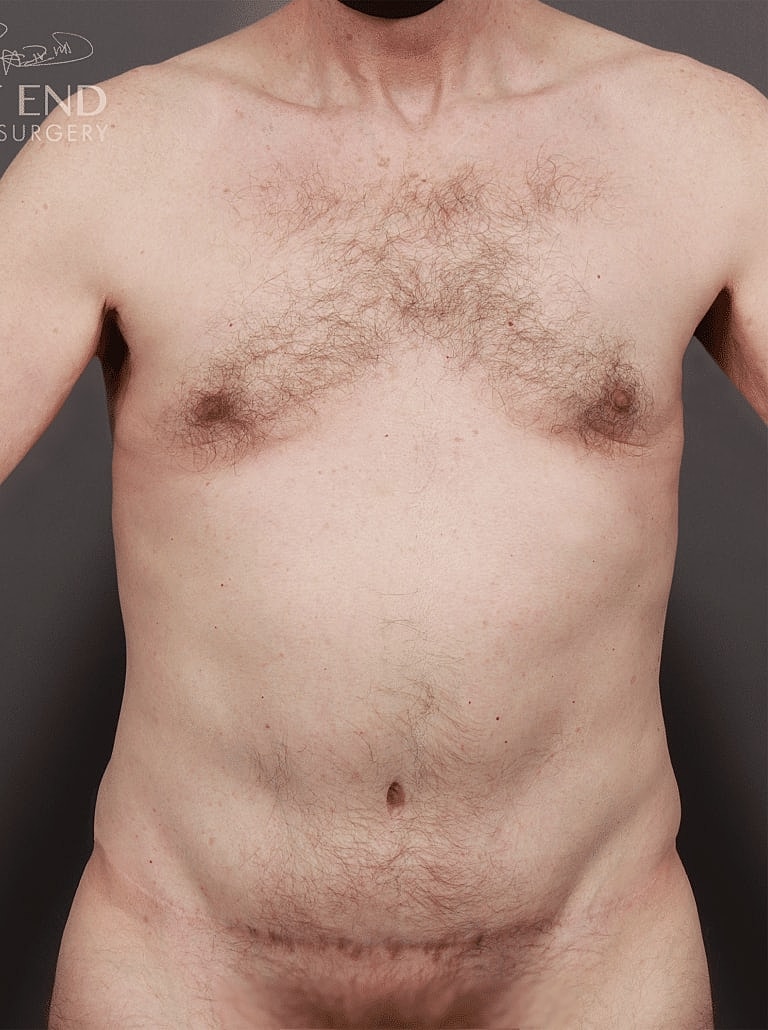 Gynecomastia Before & After