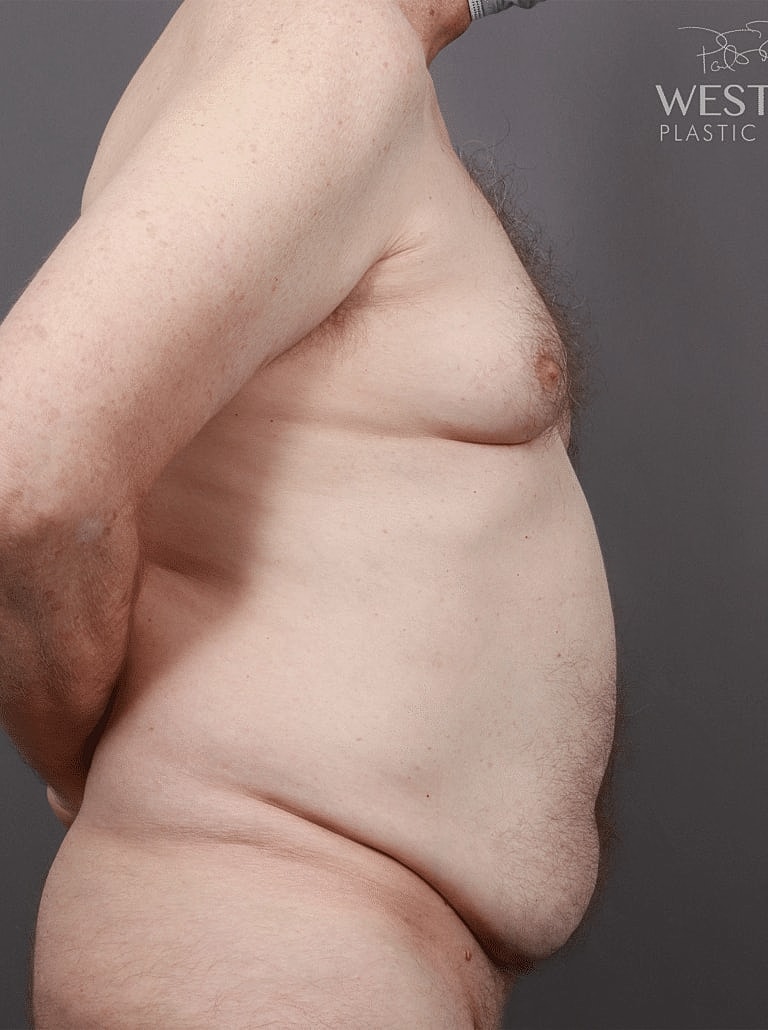 Gynecomastia Before & After