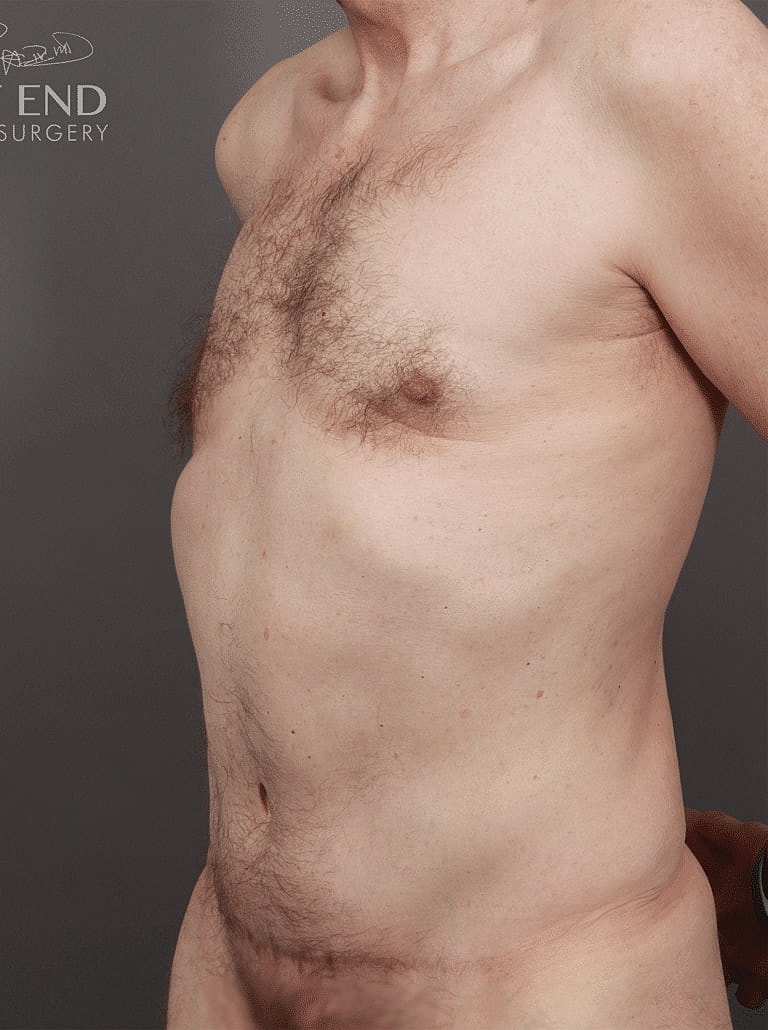 Gynecomastia Before & After