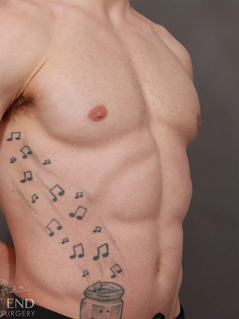 Gynecomastia Before & After