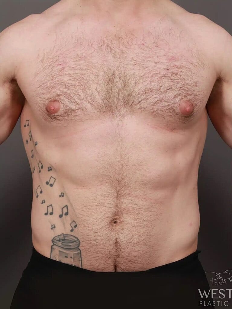 Gynecomastia Before & After