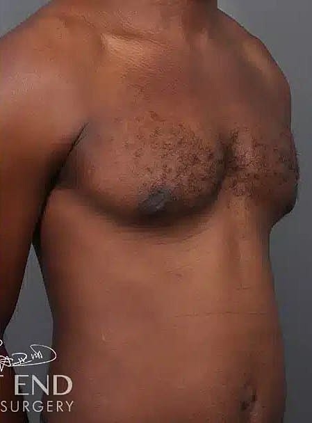 Gynecomastia Before & After