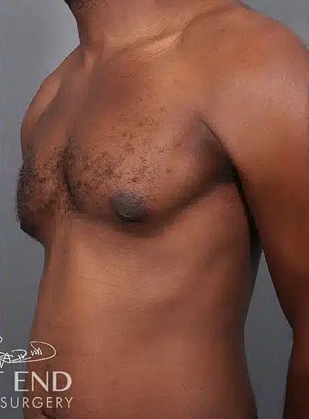 Gynecomastia Before & After