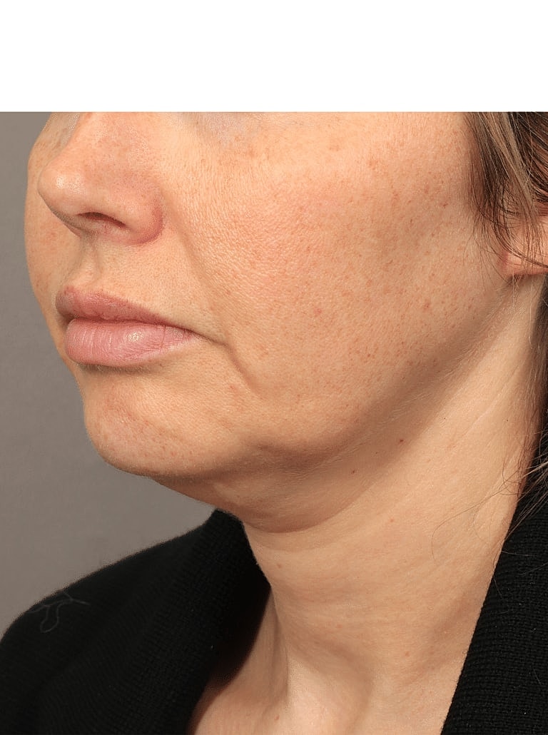 Buccal Fat Removal Before & After