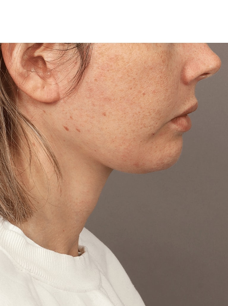 Buccal Fat Removal Before & After