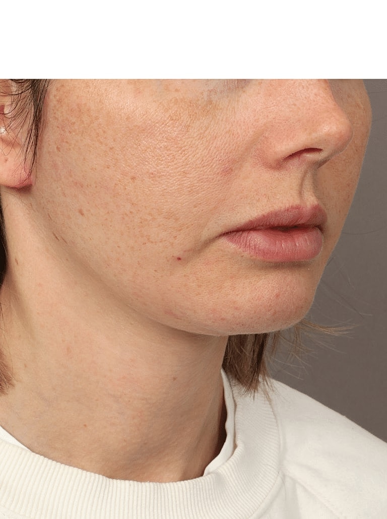 Buccal Fat Removal Before & After