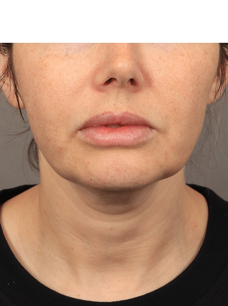 Buccal Fat Removal Before & After