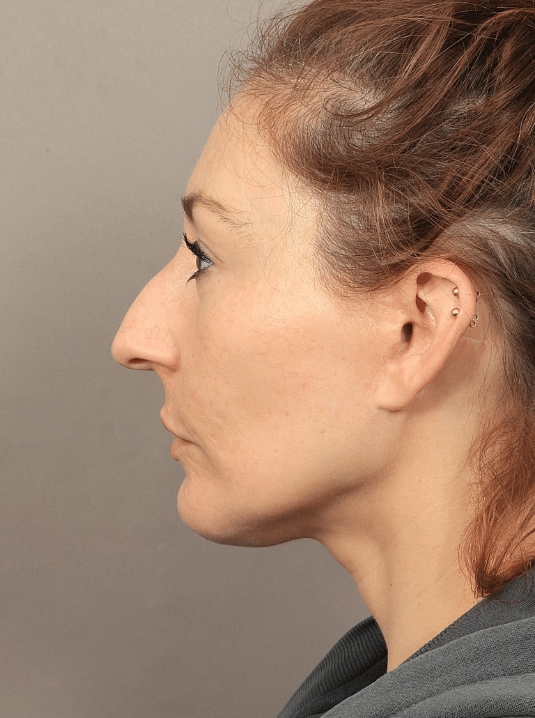 Buccal Fat Removal Before & After