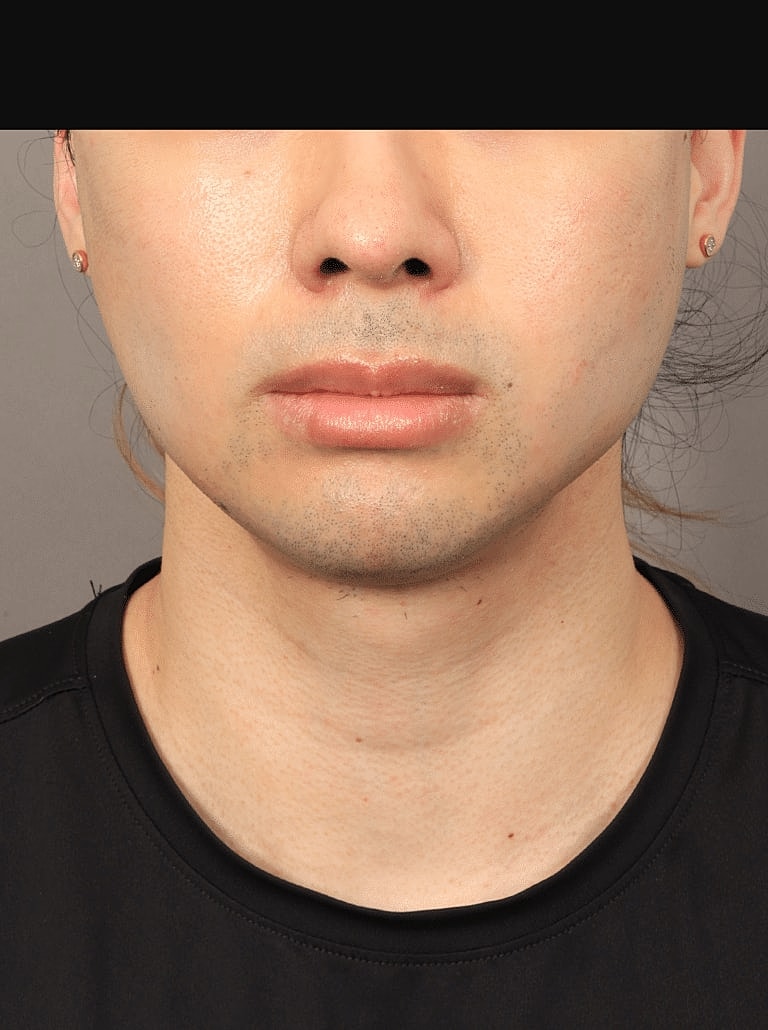 Buccal Fat Removal Before & After