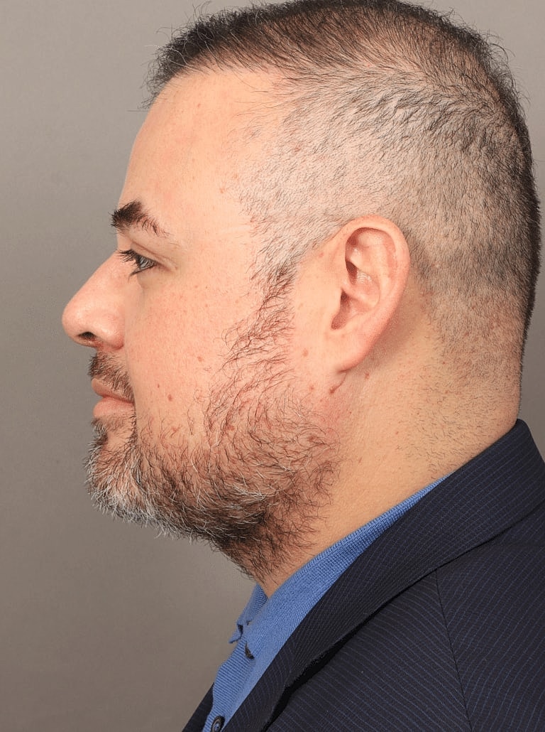 Buccal Fat Removal Before & After