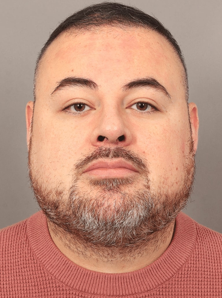 Buccal Fat Removal Before & After