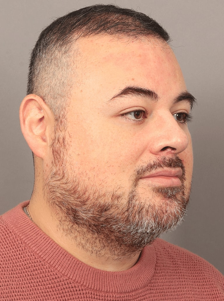 Buccal Fat Removal Before & After